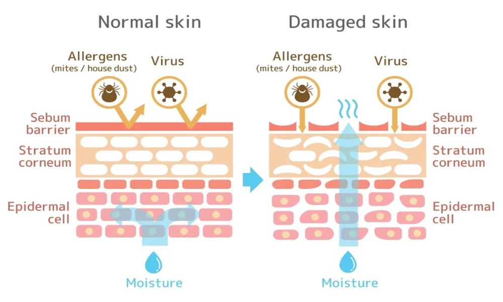 Skin barrier