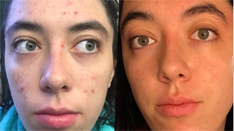 Treating acne with tretinoin before and after